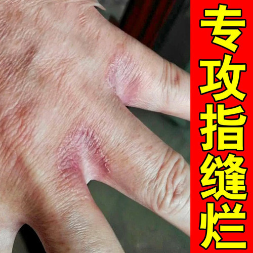 手指缝溃烂膏脱皮开裂水泡指间分离真菌感染烂手丫专药用膏