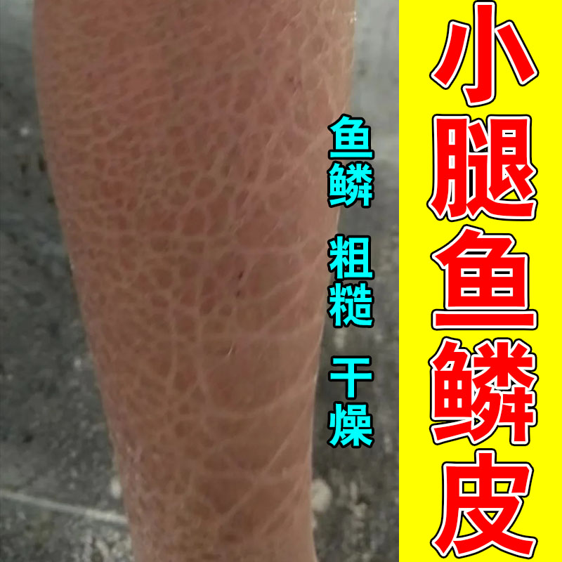 腿上皮肤干燥起皮腿上鱼鳞肤有裂纹粗糙掉皮屑修复保湿甘油