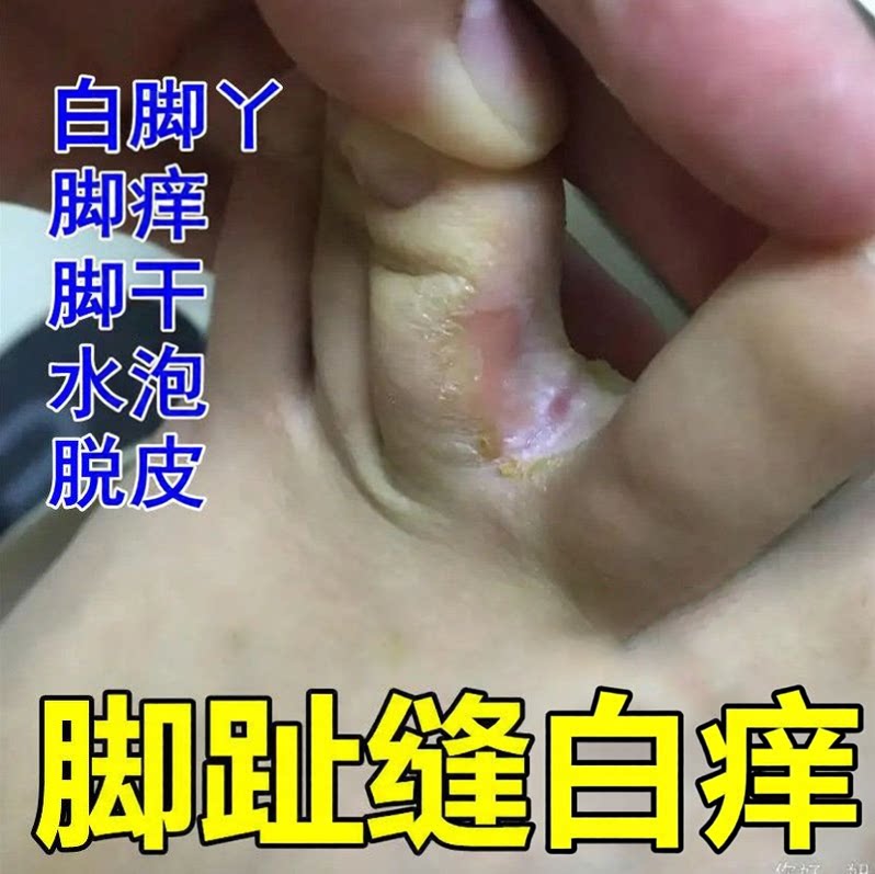脚底起白皮起皮红肿指缝开裂发白膏粗糙干燥修护膏