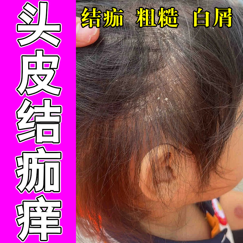 改善头发起屑发痒红肿结痂头上大片鳞屑发痒干燥修护植物膏