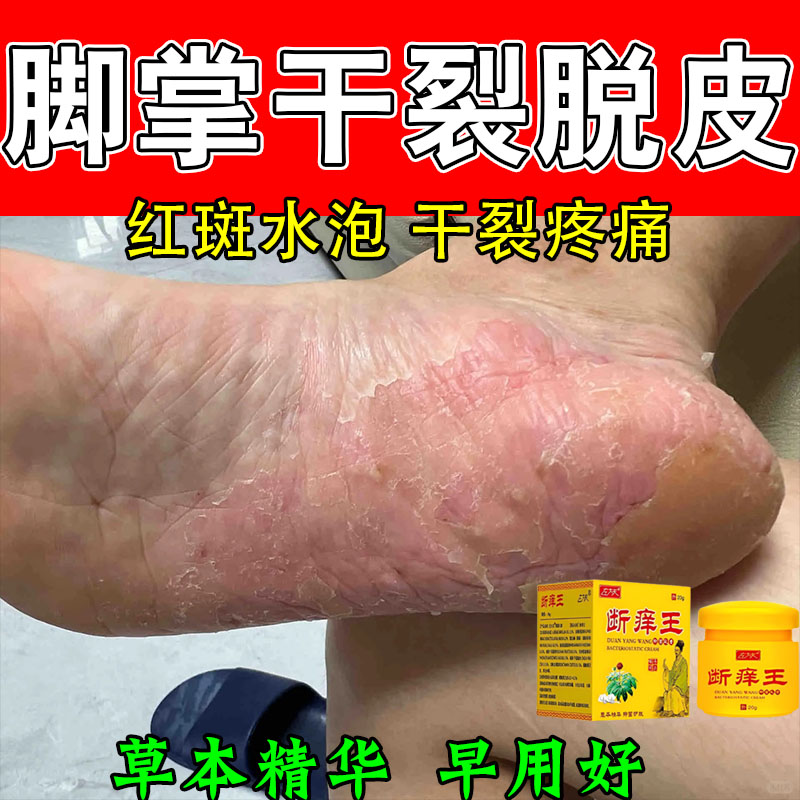 手足掌跖手脚起皮干裂粗糙角质增厚泛红开裂粗糙干燥角质厚修护膏