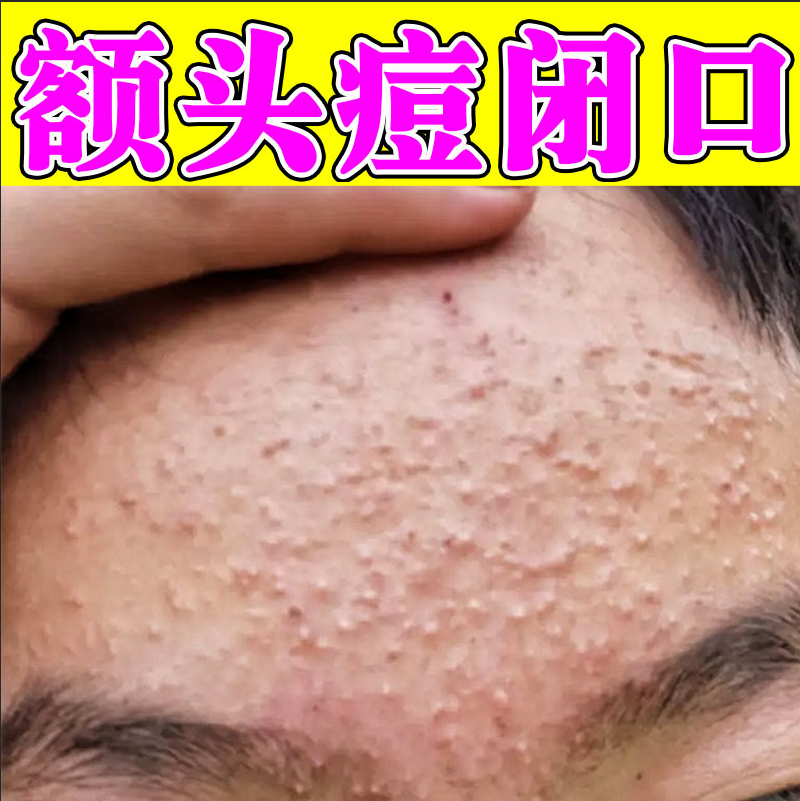 去额头疙瘩脸上起小疙瘩闭口粉刺去除脸部额头下巴