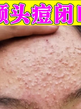 去额头疙瘩脸上起小疙瘩闭口粉刺去除脸部额头下巴