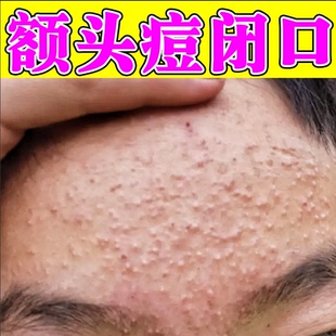 去额头痘痘脸上起小疙瘩长痘痘闭口粉刺的克星去除脸部额头下巴痘