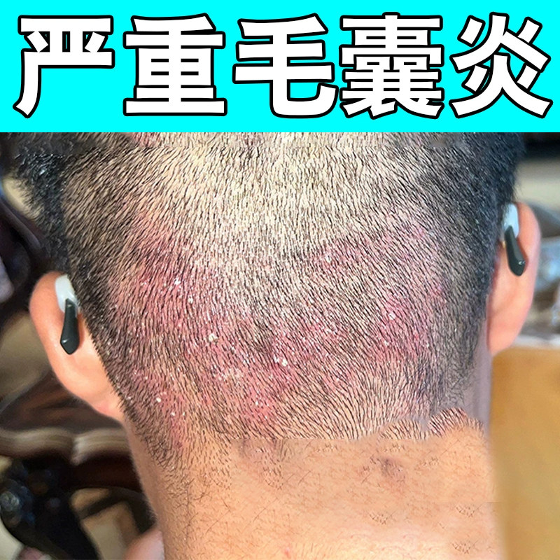 头上长痘痘毛囊炎专用有疙瘩头皮痒脓包红肿头皮起硬块头皮专用