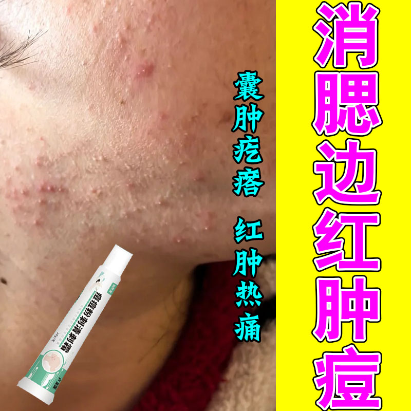 腮边下巴痘红肿硬疙瘩脓包反复不消闭口粉刺下巴专用修护草本乳膏