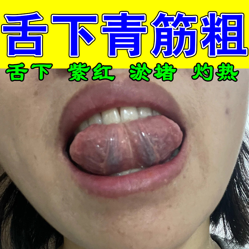 舌下青筋粗大发黑发紫舌底血管淤堵舌根红肿刺痛草本修护疏通喷剂