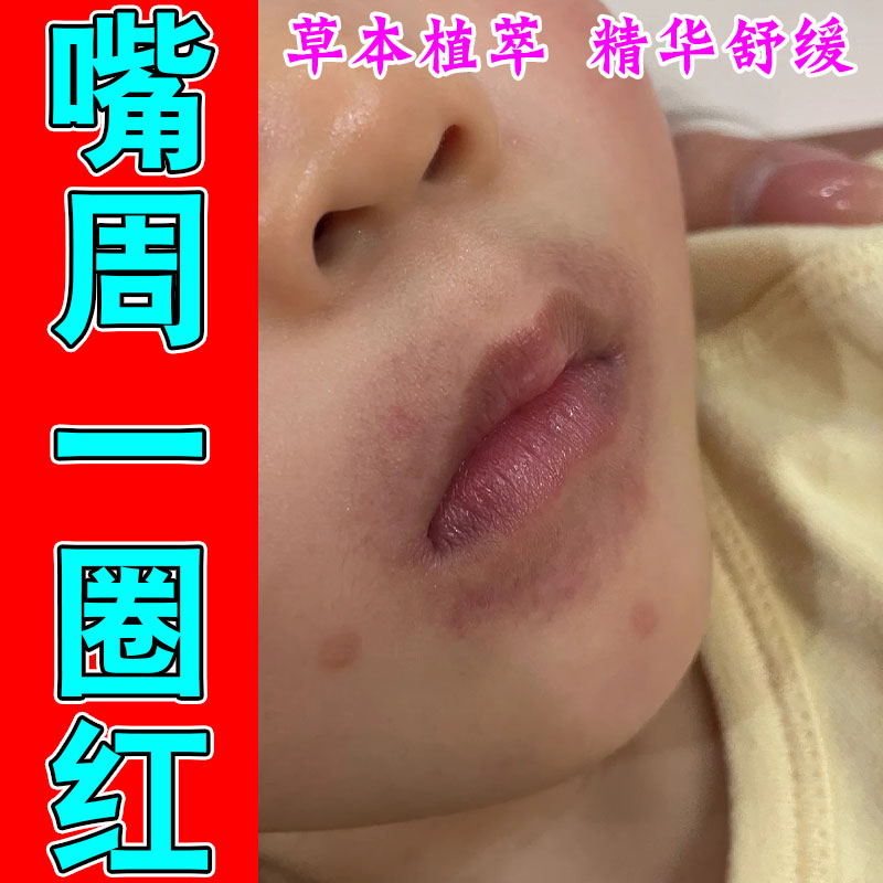 羊胡子舔嘴口周泛红结痂干疼起皮粗糙不适草本保湿修护膏