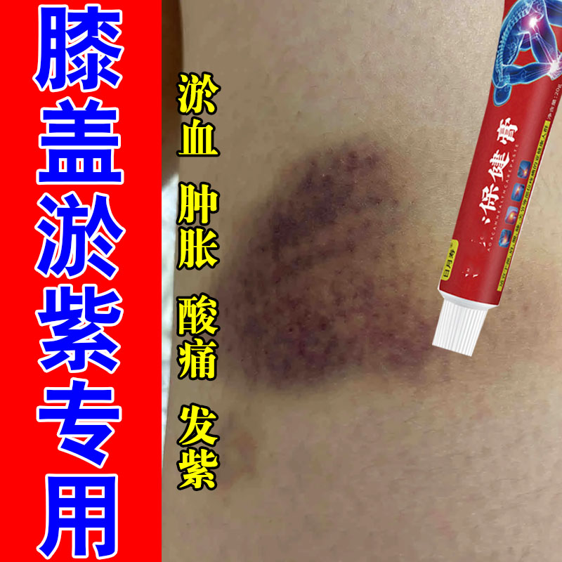 去腿上淤青消活血化瘀膝盖摔磕碰撞伤发紫疼跌打损伤草本软膏
