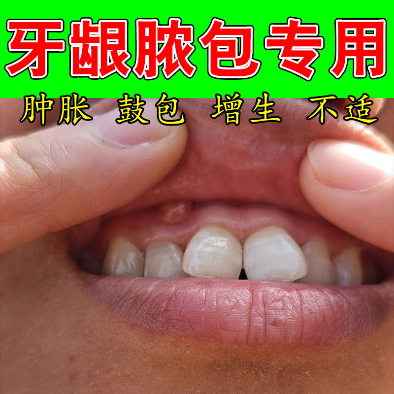 冶牙龈脓包肿痛上火肿包息肉增生口腔上火牙周肿舒缓修护喷剂