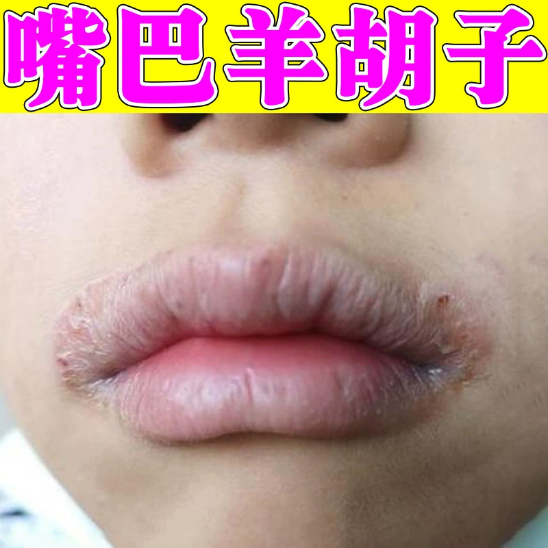 羊胡子疮儿童嘴巴一圈红痒刺痛口周专用唇膏防孩子舔嘴唇干裂红肿