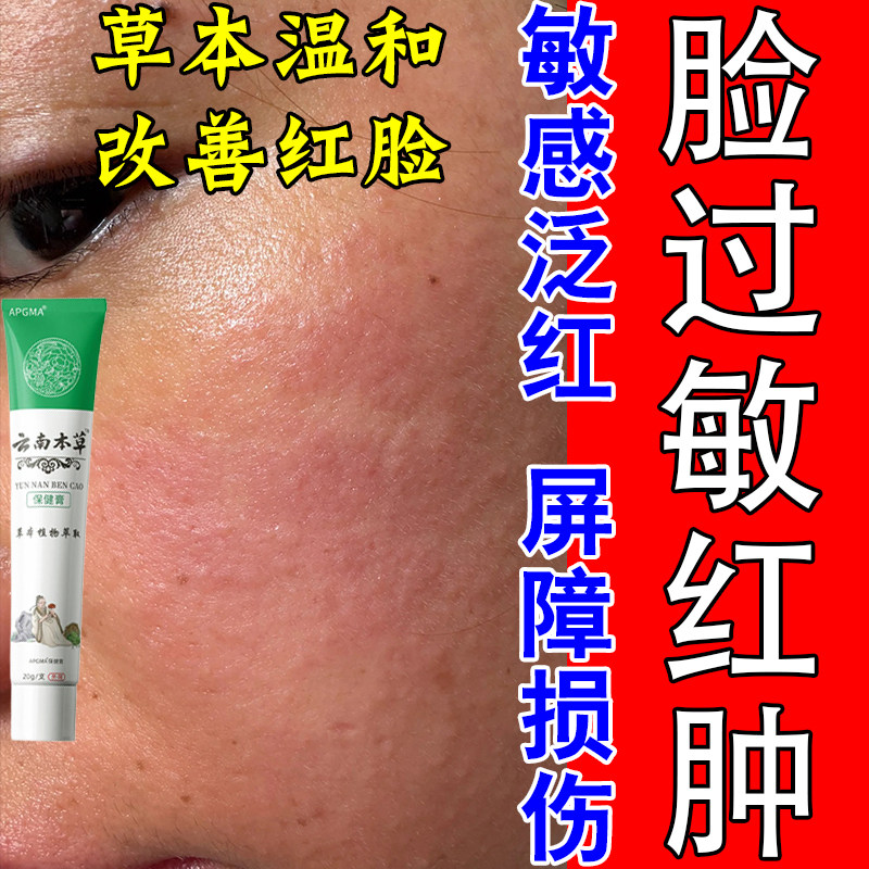 过敏脸部皮肤晒伤泛红痒刺痛肿热明显草本舒缓保湿膏