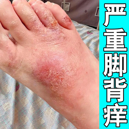 冬天脚背脚面脚杆脚上起红疙瘩红点脚背红肿