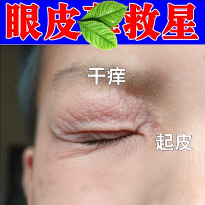 眼皮红肿干燥起皮眼周红肿上眼皮红肿掉皮屑眼角起皮