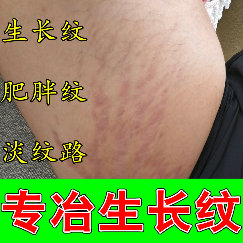 生长纹淡化学生后背淡化生长纹乳膏淡紧致肚皮肥胖纹修复膏