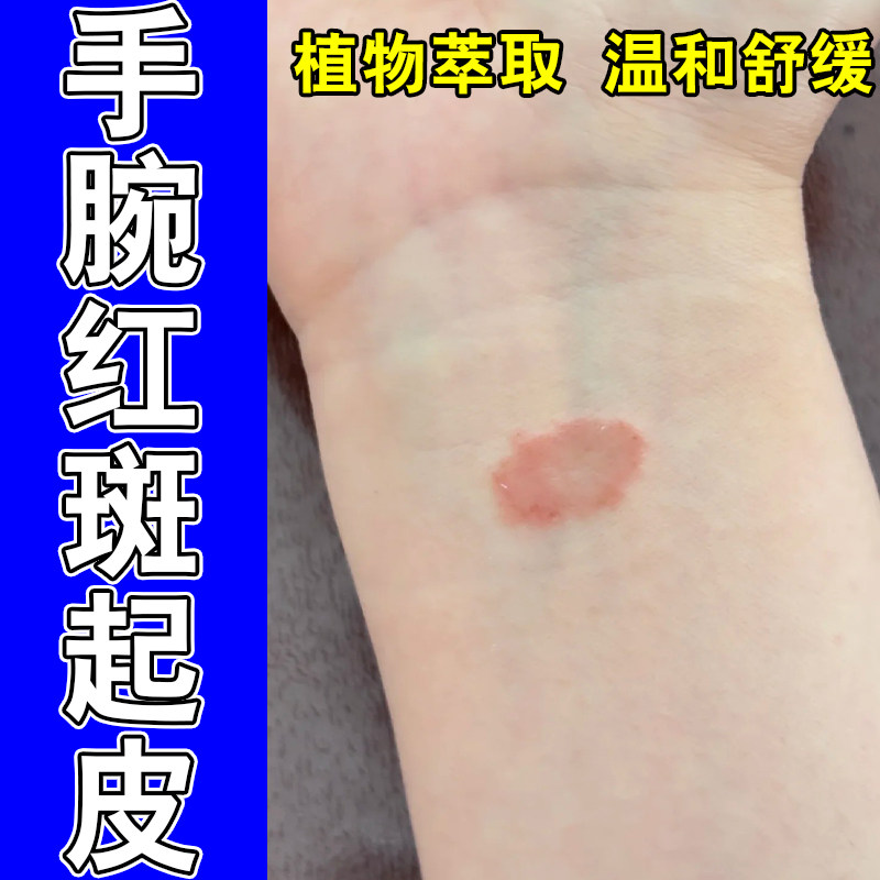 常年手腕干皮粗糙红肿发痒起白屑手泛红温和草本修护软膏