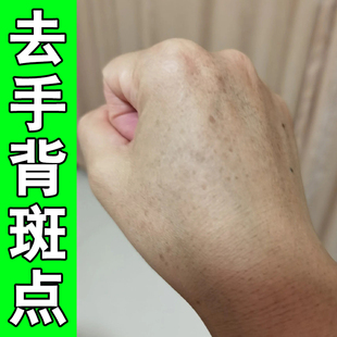 手上老年斑手背脸上手部老人斑手背晒黑斑黄褐斑黑色素沉淀精华膏