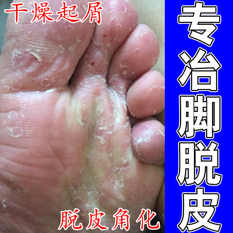 脚上脱皮脚底脚心掉皮脱皮专用膏脚皮肤粗糙干燥草本保湿修护膏