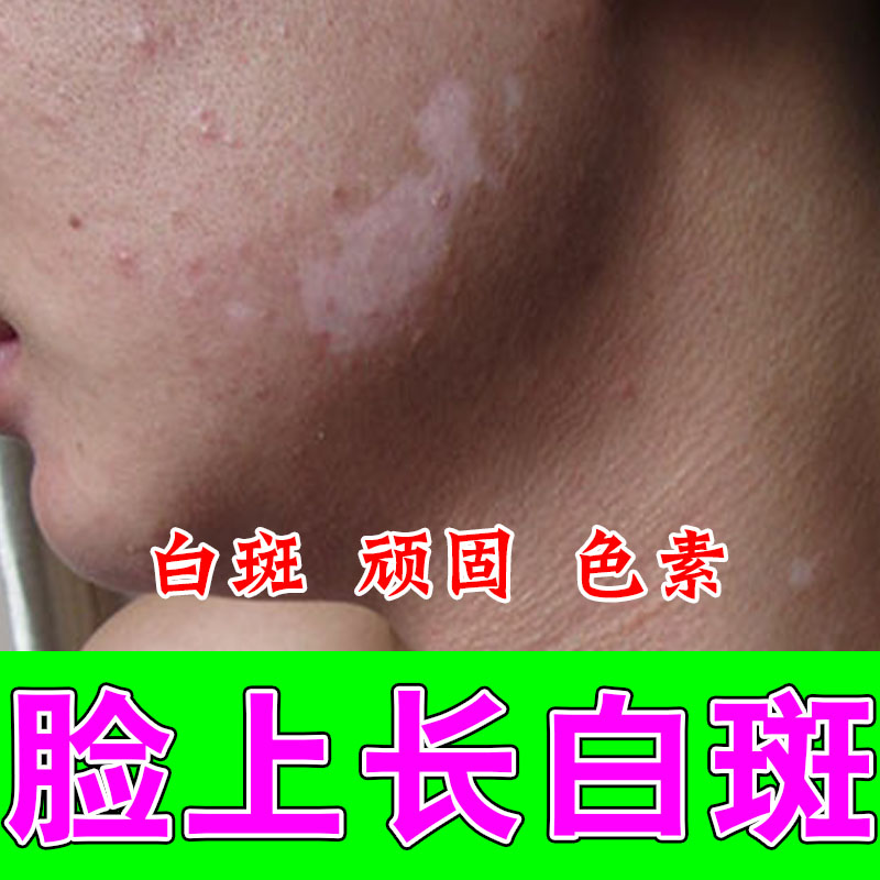 脸上长白斑花斑深色干燥粗糙人脸部全身可用一抹草本修护乳膏