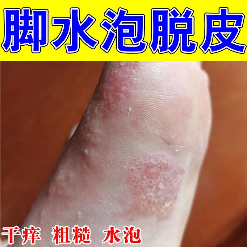 脚底起水小泡痒红肿起皮干燥粗糙脚底水泡粗糙角质疙瘩痒乳膏