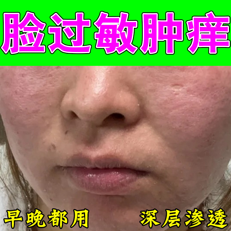去红血丝改善脸部敏感肌退红修护泛红皮肤屏障受损修复角质层软膏