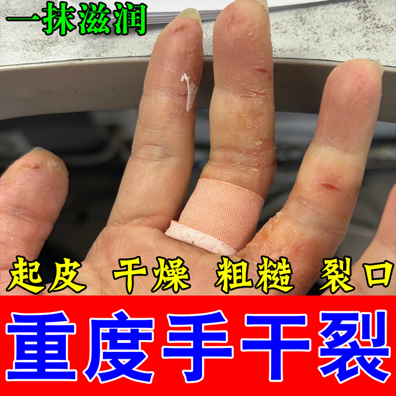 手指边缘裂口干裂手指头裂口子脱皮手干燥粗糙保湿舒缓草本乳膏