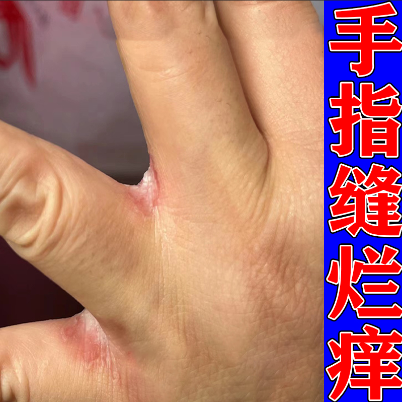 烂手丫手指缝溃烂手气脱皮起皮手指缝开裂脱皮发红修复膏专用软膏