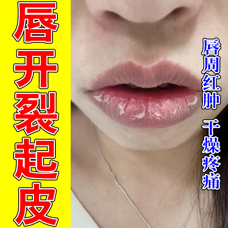 嘴巴保湿乳膏嘴唇干裂脱皮用冶儿童成人剥脱性唇起皮修复膏乳