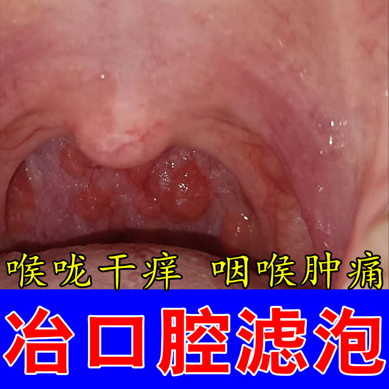 喉咙淋巴滤泡增生疙瘩咽喉壁泛红灼热有异物感水泡红肿疼喷剂