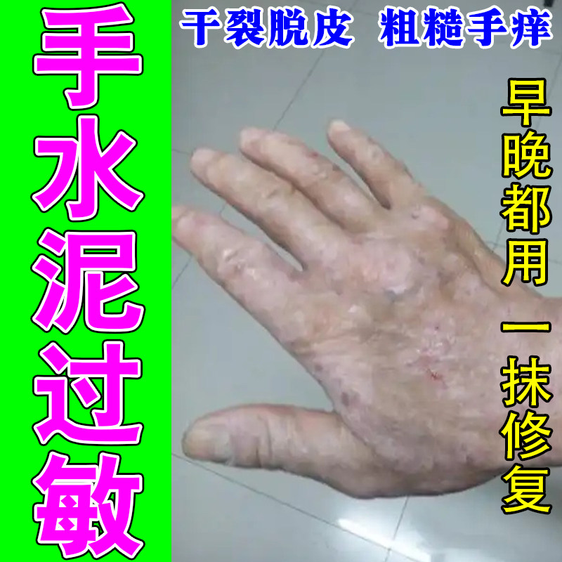 水泥过敏痒手上红肿干燥痒裂口粗糙脱皮干裂红肿植物舒缓修护乳膏