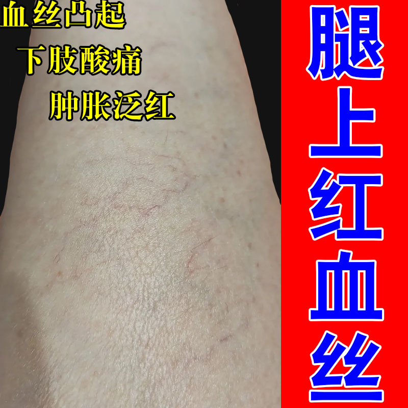 冶腿上红血丝血管扩张修护腿上红紫血丝青筋凸起发痒明显草本膏