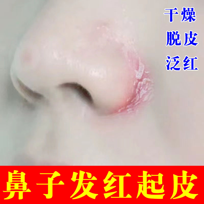 鼻子两侧发红起皮鼻子两边干燥鼻子干脱皮鼻翼两边红肿去皮滋润膏