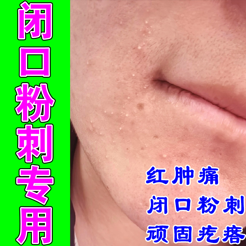闭口粉刺下巴反复长痘脸上小疙瘩小颗粒学生青春痘草本修护乳膏