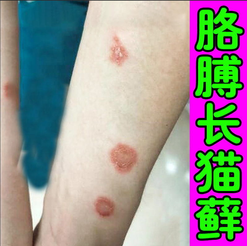 人用猫藓药真菌感染人患狗猫藓皮肤皮藓红肿长红斑红块藓专用软膏