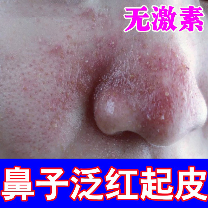 鼻子两侧发红脱皮鼻翼两边泛红干燥修复红血丝油脂溢性酒糟鼻软膏