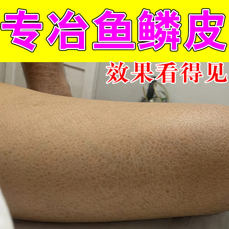 冶鱼鳞状皮肤干燥起皮腿上鱼鳞肤有裂纹粗糙掉皮屑修复保湿甘油