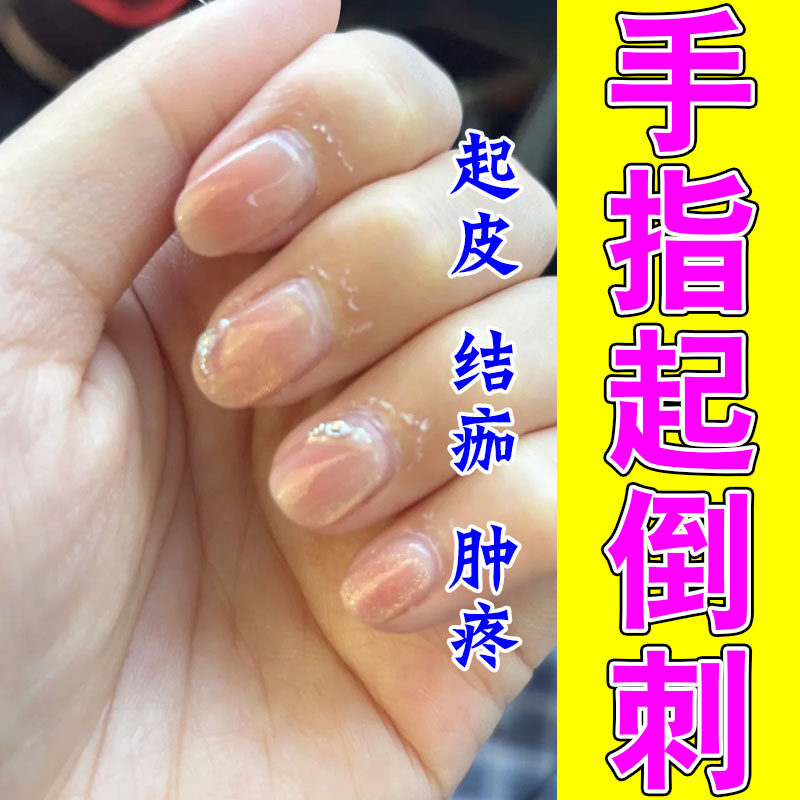 手起倒刺修复草本膏乳儿童手指甲边缘皮硬皮倒起皮粗糙保湿乳