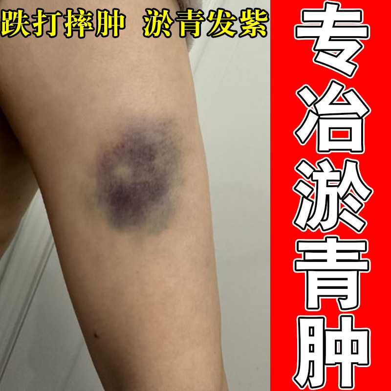身上淤青撞伤活血化瘀磕碰撞伤摔伤发紫皮下淤血淤外用修护膏