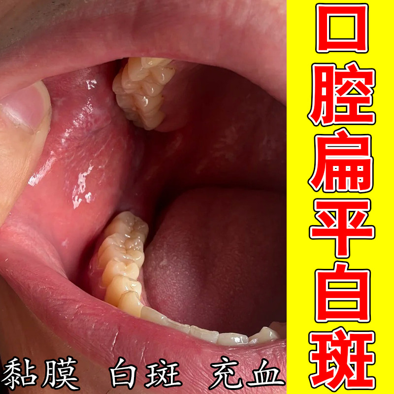 冶口腔扁平黏膜粘膜修护白斑反复口腔纤维化黏膜修护植物喷剂