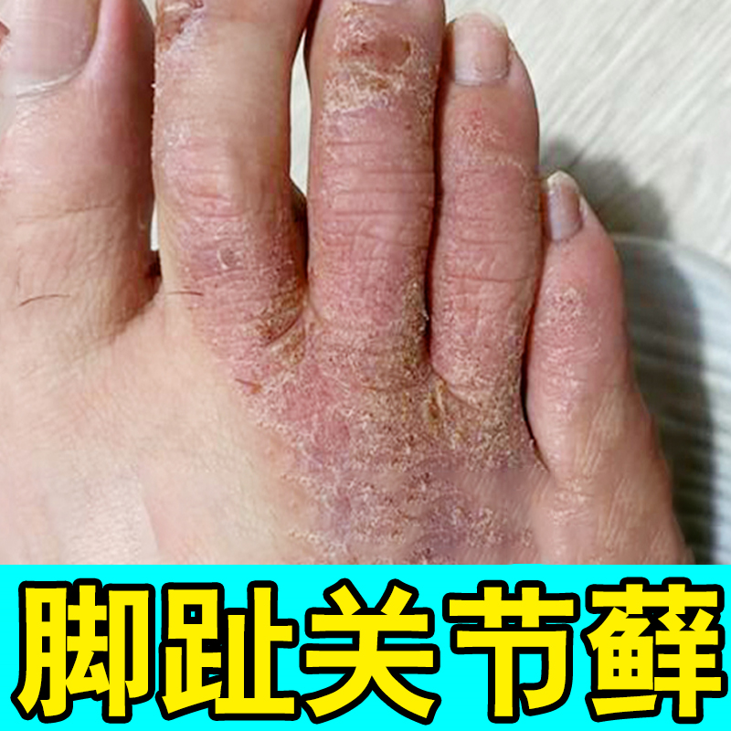 冶疗脚趾头上长脚背痒脚趾关节干燥起皮脱皮刺挠起皮专用软膏
