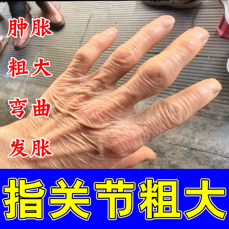 指头粗大专用修护膏缓解老年骨节鼓包僵硬屈伸不畅手关节痛软膏
