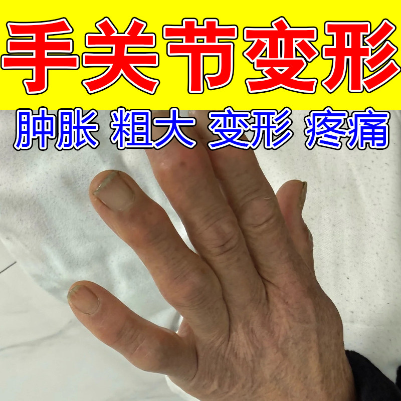 手部关节舒缓草本萃取改善中老年手指肿大僵硬鼓屈伸僵硬修护膏