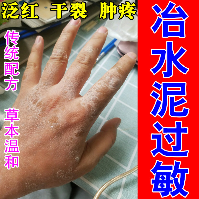 水泥过敏手部红肿干燥脱皮干裂裂口粗糙刺痛植物舒缓修护乳膏