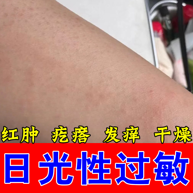 冶胳膊紫外线过敏疙瘩红肿日光神经性过敏皮肤过敏手臂疙瘩修护膏