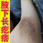 腋下红肿疼痛烂咯吱窝长疙瘩出汗引起小红疙瘩淹红烂肿专用软膏