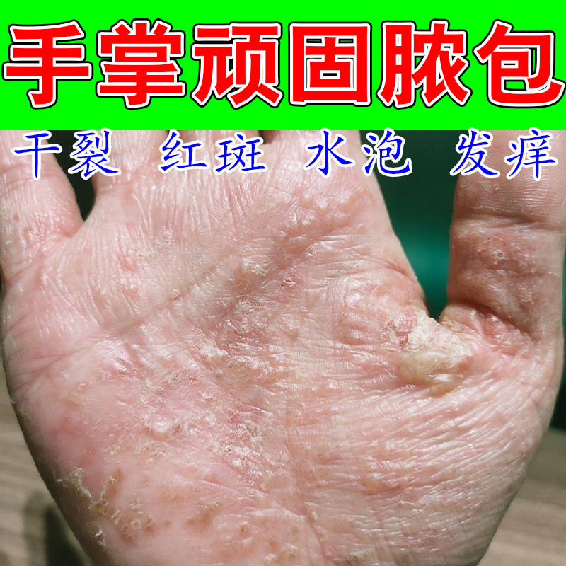手掌跖角质手手干燥起皮脱皮干裂泛红粗糙肌肤舒缓养护外用膏