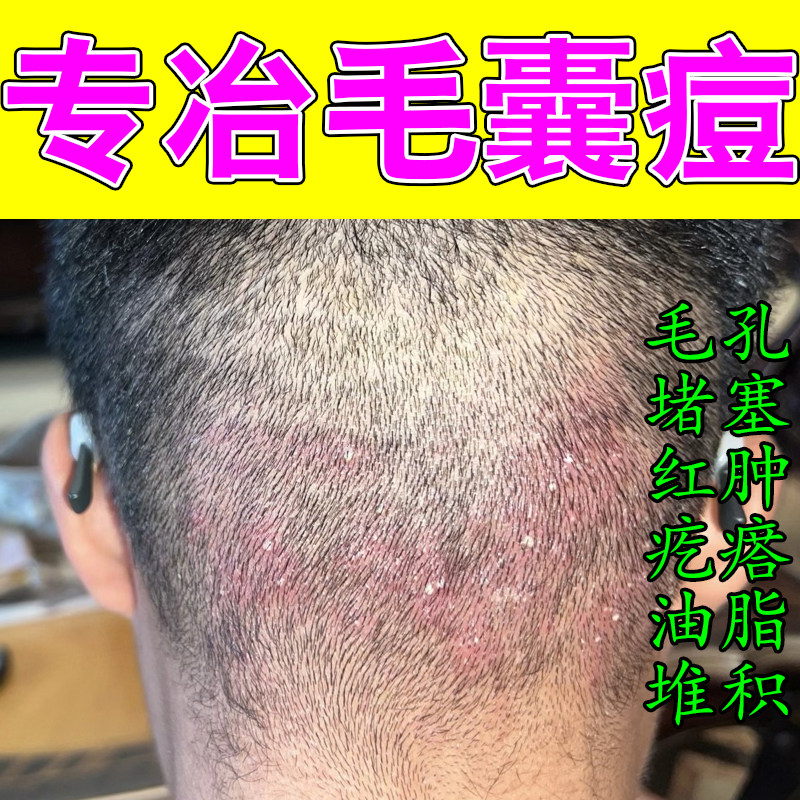 后脑勺头皮长红疙瘩溢脂性皮毛囊红肿起红痘脖子上起脓包乳膏