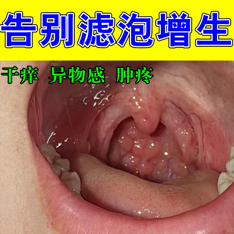 咽喉淋巴滤泡增生喉咙舌壁发红发热异物感水泡红肿咽喉喷剂