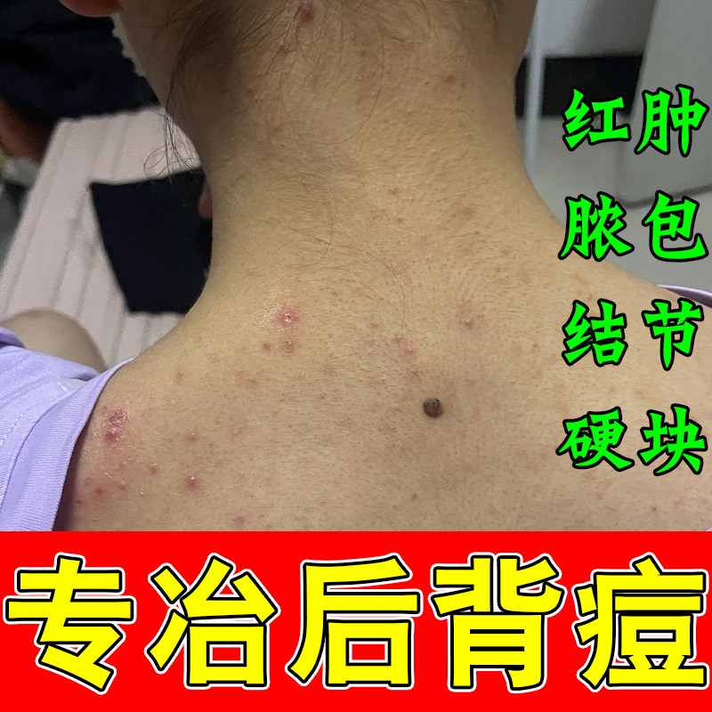冶后背长痘胸口身体背上长有痘红硬发痒毛囊疙瘩密集草本修护膏