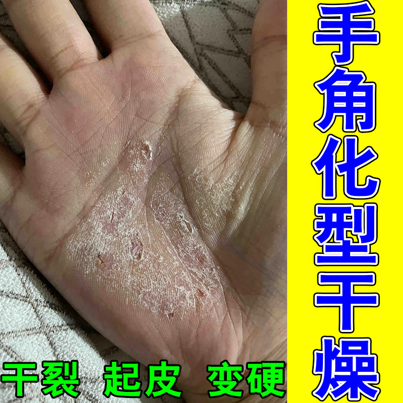 角化型手起皮干裂手掌粗糙增厚裂口角质增厚变硬草本修护软膏